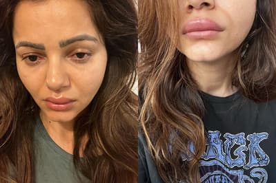 Rubina Dilaik Share Picture Of Swellen Face And Lips Goes Viral