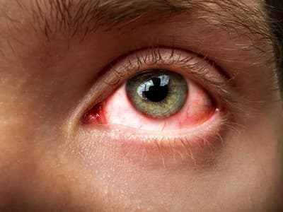 eye-flu-or-conjunctivitis-cases-rise-in-delhi-dr-told-symptoms-treatment-and-prevention-tips-of-pink-eyes-101815410.jpg