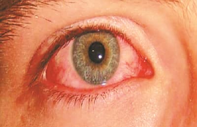 Eye Flu (conjunctivitis) : आई फ्लू के मरीज 19000 पार, CM ने ली इमरजेंसी मीटिंग, रोकथाम के लिए बनाई खास योजना
