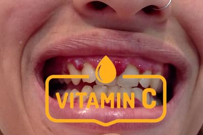 Symptoms of Vitamin C